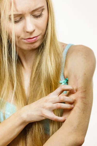皮肤发痒 食物过敏 发痒的女人 带着过敏的皮疹挠着胳膊 — 图库照片