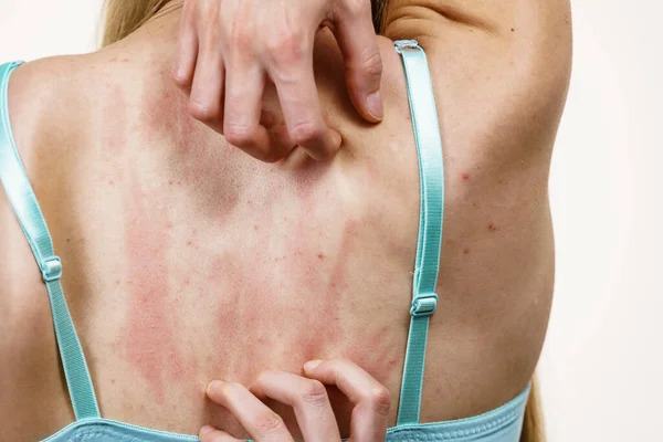 Woman Allergy Rash Scratching Her Itchy Back Young Female Acne — Zdjęcie stockowe