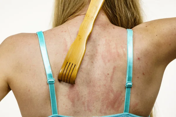 Jeukende Huid Dermatitis Voedselallergieën Een Vrouw Die Hout Krabt Haar — Stockfoto