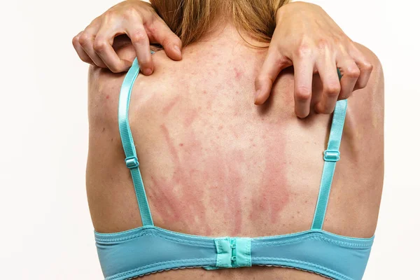 Jovem Mulher Sofrendo Coceira Pele Coceira Nas Costas Reação Alérgica — Fotografia de Stock