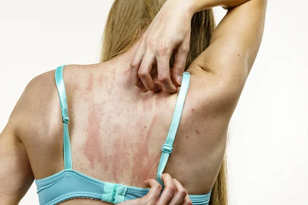 年轻女人的皮肤发痒 背痒痒 对食物过敏 保健服务 — 图库照片