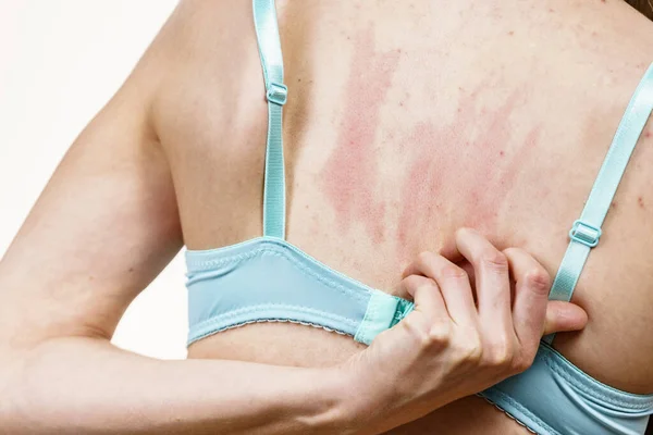 Woman Allergy Rash Scratching Her Itchy Back Young Female Acne — Foto de Stock