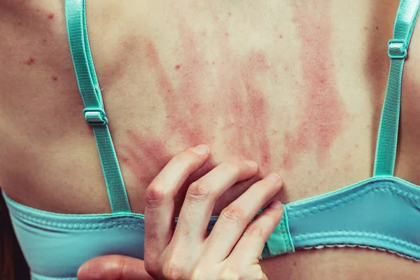 Health problem, skin diseases. Young woman showing her back with acne, red spots. Female scratching her itchy body with allergy rash.