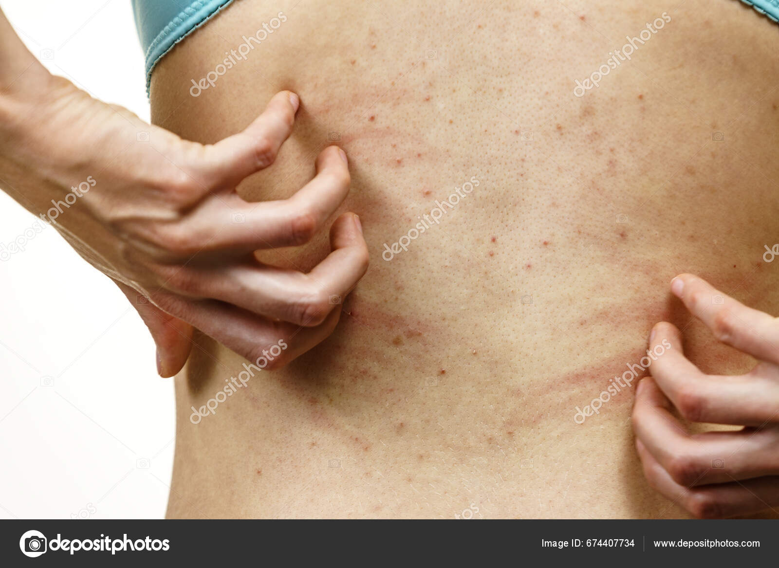 Itchy Skin Dermatitis Food Allergies Woman Showing Her Back Acne Stock  Photo by ©Voyagerix 674407734