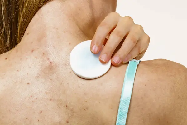 stock image Treatment for adult acne problem. Woman with red spots on back. Female cleaning skin, using cotton pad.