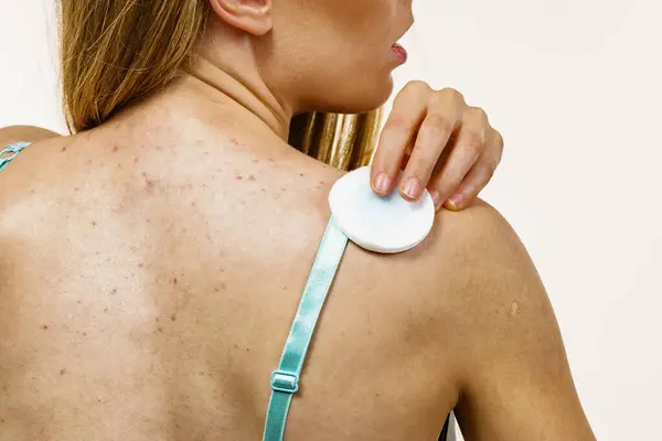 stock image Health problem, skin diseases. Young woman with acne, red spots on back. Female cleaning skin, using cotton pad.