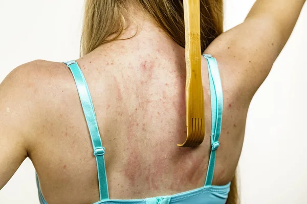 Jeukende Huid Dermatitis Voedselallergieën Een Vrouw Die Hout Krabt Haar — Stockfoto