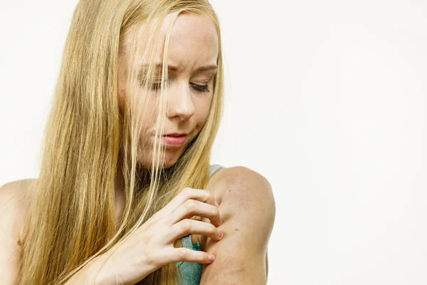 Jeukende Huid Dermatitis Voedselallergieën Vrouw Met Jeuk Krassen Haar Arm — Stockfoto
