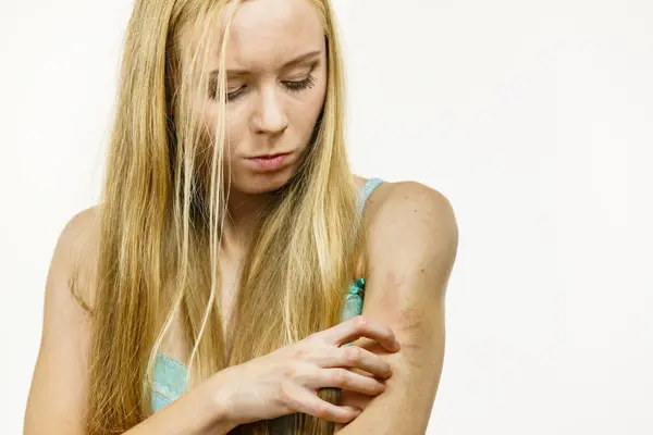 Jeukende Huid Dermatitis Voedselallergieën Vrouw Met Jeuk Krassen Haar Arm — Stockfoto