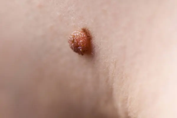 Unrecognizable Person Having Dark Fibroma Dermatology Problem Skin Close Papilloma — Stock Photo, Image