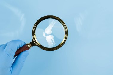 Kırmızı noktalı insan iskeletinin diz kapağında büyüteç camlı pankart. Diz ağrısı. Burkulmuş bağlar, menisküs yırtığı, tendinit, çıkık. Uzayı kopyala Yüksek kalite fotoğraf