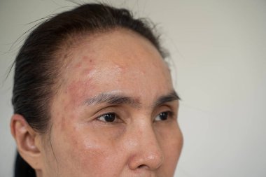 Yüzünde akne sorunu olan Asyalı bir kadın var. Sivilceli genç bir kadının yüzü kesilmiş, alnında kızarıklık var. Alerjiler, sivilceler, hormonal değişiklikler. Sorunlu cilt.