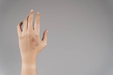 Hasta bileğindeki alerjik deri iltihabını kapat. Kadınlar kaşıntıyı elle, kolla, kaşıntıyla kaşıyorlar. Sağlık ve Tıp Kurumu Konsepti.