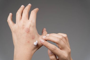 Bir kadın bileğine kaşıntı önleyici krem sürüyor. Egzama, sedef ve mantar, plaket, kızarıklık gibi diğer deri hastalıklarının tedavisinde merhem, krem kullanıyor. Otoimmün genetik hastalık