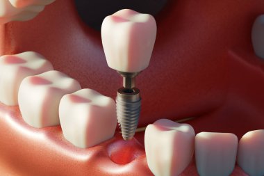 Diş implantı vidası, yerleştirme prosedürü