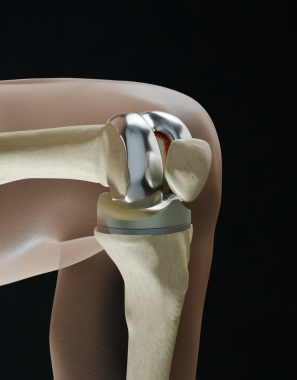 X-Ray Toplam Diz Yenilemesi, dizin hastalıklı veya hasarlı eklem yüzeylerini metal ve plastik protez cihazlarla değiştirmek için yapılan ameliyattır..