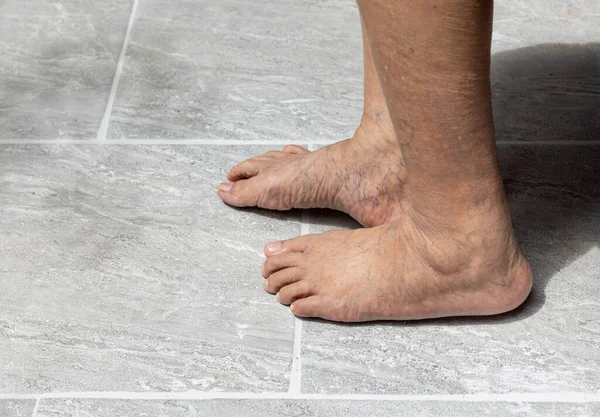 Ноги Пожилой Женщины Варикозным Расширением Вен — стоковое фото