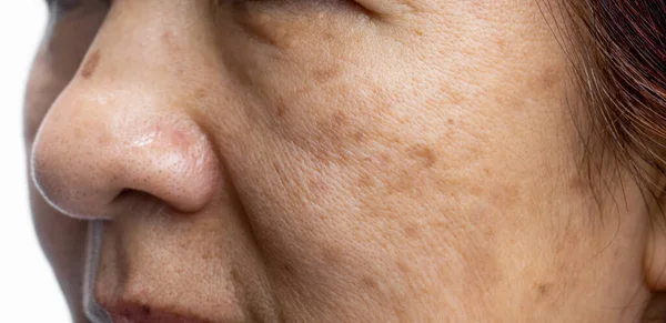 Mulheres Menopausadas Preocupam Com Melasma Rosto — Fotografia de Stock