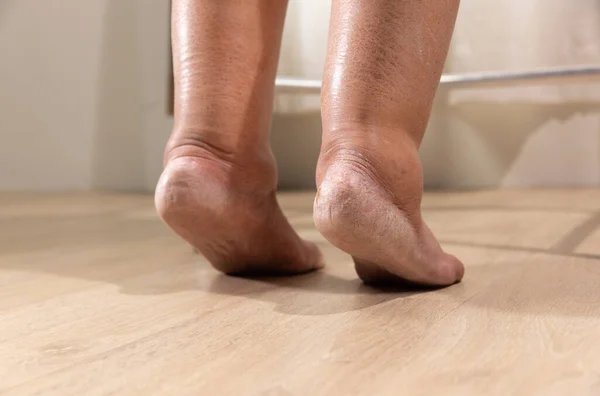 Kanser Tedavisinden Sonra Kadının Bacağında Ödem Var — Stok fotoğraf