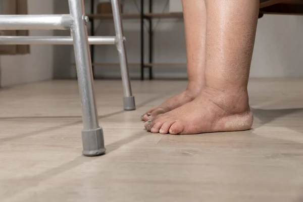 Γυναικείο Πόδι Είναι Οίδημα Πρήξιμο Μετά Θεραπεία Του Καρκίνου — Φωτογραφία Αρχείου