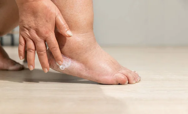 Woman apply moisture lotion on edema (swelling) leg after cancer treatment. Broken heel.