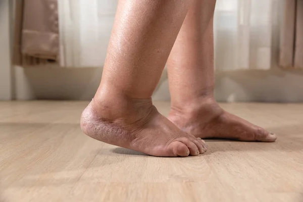 Нога Женщины Отек Отек После Лечения Рака — стоковое фото