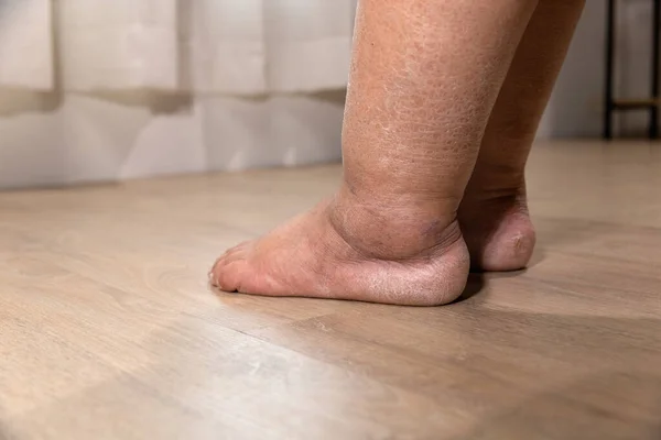 癌症治疗后妇女的腿水肿 — 图库照片