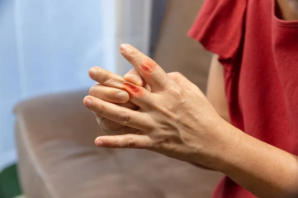 Senior Vrouw Massage Vinger Met Pijnlijke Gezwollen Jicht — Stockfoto