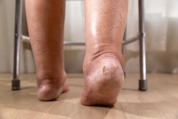 Woman Leg Edema Swelling Cancer Treatment — Stock Photo, Image