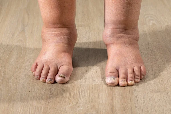 癌症化疗导致脚踝肿胀 脚踝水肿 — 图库照片