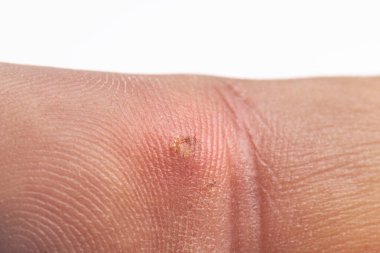 Tahta kıymığından enfeksiyon kapmış parmak.