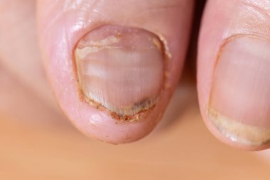 Cancer chemotherapy cause nails brittle or flaky. clipart