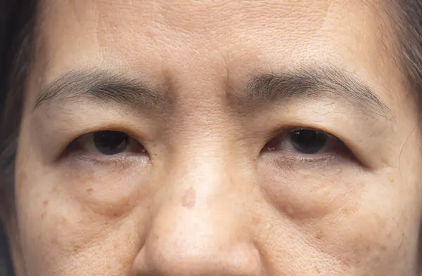 Senior Asiático Mujer Preocuparse Acerca Ojo Bolsas Oscuro Mancha Fotos de stock