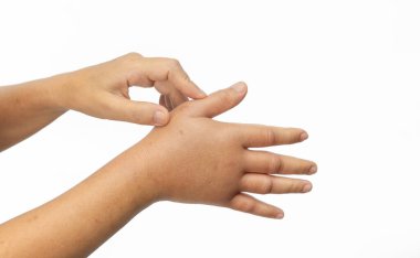 Böcek sokmasına alerjisi olan şişmiş bir el. Cilt alerjisi.