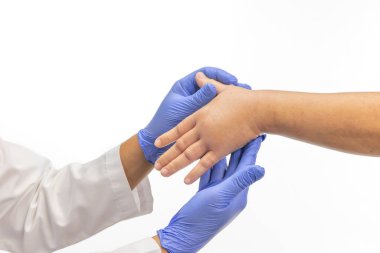 Böcek sokmasına alerjisi olan şişmiş bir el. Cilt alerjisi.