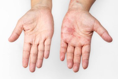 Kolda Zona, Zoster veya Herpes Zoster belirtileri.