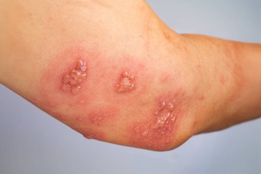 Kolda Zona, Zoster veya Herpes Zoster belirtileri.