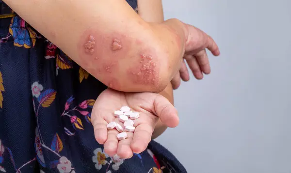 stock image Shingles, Zoster or Herpes Zoster symptoms on arm.