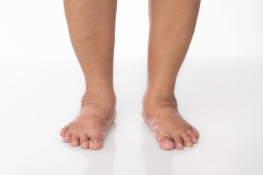 Kilolu yaşlı kadınlar ve ayak bilekleri şişmiş..