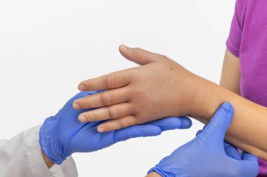 Böcek sokmasına alerjisi olan şişmiş bir el. Cilt alerjisi.