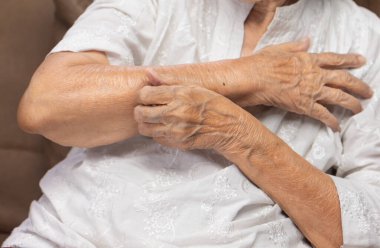 Yaşlı bir kadın kaşınıyor ve kolları kaşınıyor..