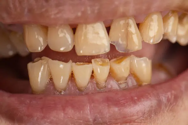 stock image Attrition tooth due to interaction with other teeth in elderly woman.