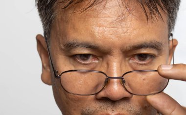 Bilgisayar veya dijital ekranlarda uzun süre çalıştıktan sonra yaşlı adamın göz yorgunluğu.