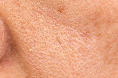 Son sınıf öğrencisi kadın, yüzündeki gözenek, deri ve siyah noktalar için endişeleniyor..