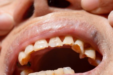 Yaşlı kadınlarda diğer dişlerle olan etkileşimden dolayı aşınma dişi.