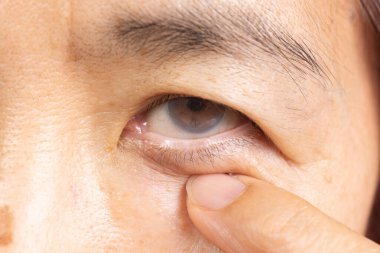 Yaşlı kadında katarakt var. Genellikle, kataraktlar yaşlı insanlarda yaygındır..