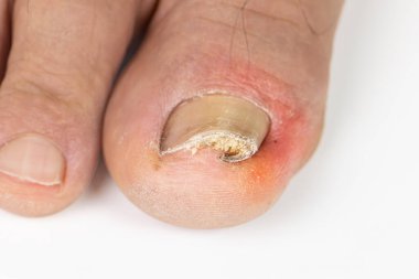 Yaşlı bir ayaktaki büyümüş ayak tırnağı ve beyaz bir sırtı var.