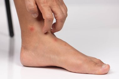 Alt bacak ve ayak derisindeki pire ısırıklarının yakın görüntüsü.