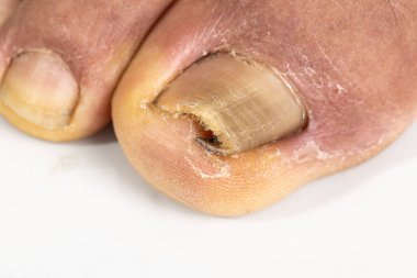 Yaşlı bir ayaktaki büyümüş ayak tırnağı ve beyaz bir sırtı var.