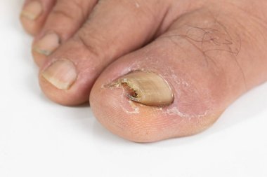 Yaşlı bir ayaktaki büyümüş ayak tırnağı ve beyaz bir sırtı var.